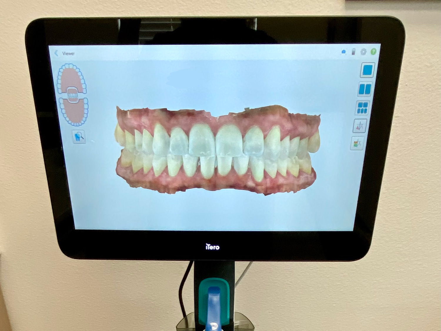 Result of itero dental scanner
